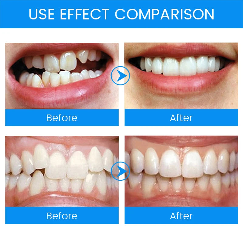1 Set Teeth Retainer Bruxism Mouth Guard 3 Stages Dental Orthodontic Braces Teeth Straightener Stop Sleeping Anti-Snoring Device